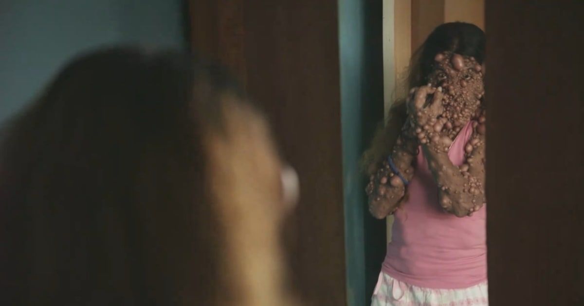 'Take My Tumour' patient, Charmaine Sahadeo is hardly able to move due to hundreds of tumors all over her body (X/TLC)