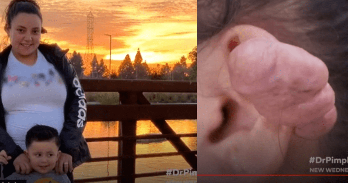 'Dr Pimple Popper': Evelyn is free of her keloids thanks to Dr Sandra Lee