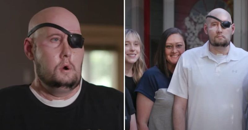 Who is Aaron James? Arkansas military veteran receives world’s first whole-eye and partial-face transplant