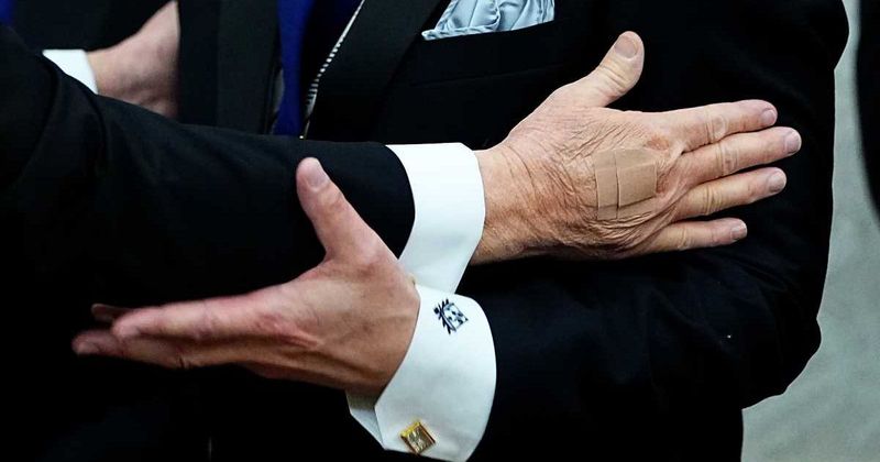 ‘Bruises spread’: Report reveals alarming claims about Trump’s ‘hole in hand’