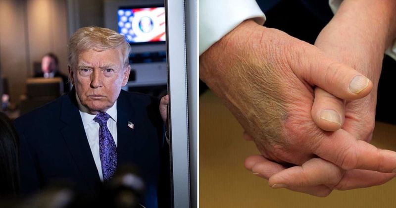 Trump’s bruised hands are ‘completely normal’, Fox News doctor says
