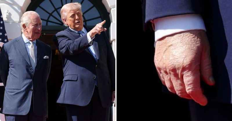 Trump’s ‘left-hand discoloration’ resurfaces in photos with King Charles, health concerns resurface